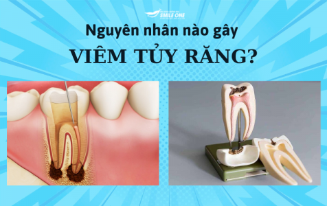 Viêm tuỷ răng: Khái niệm, nguyên nhân và cách điều trị